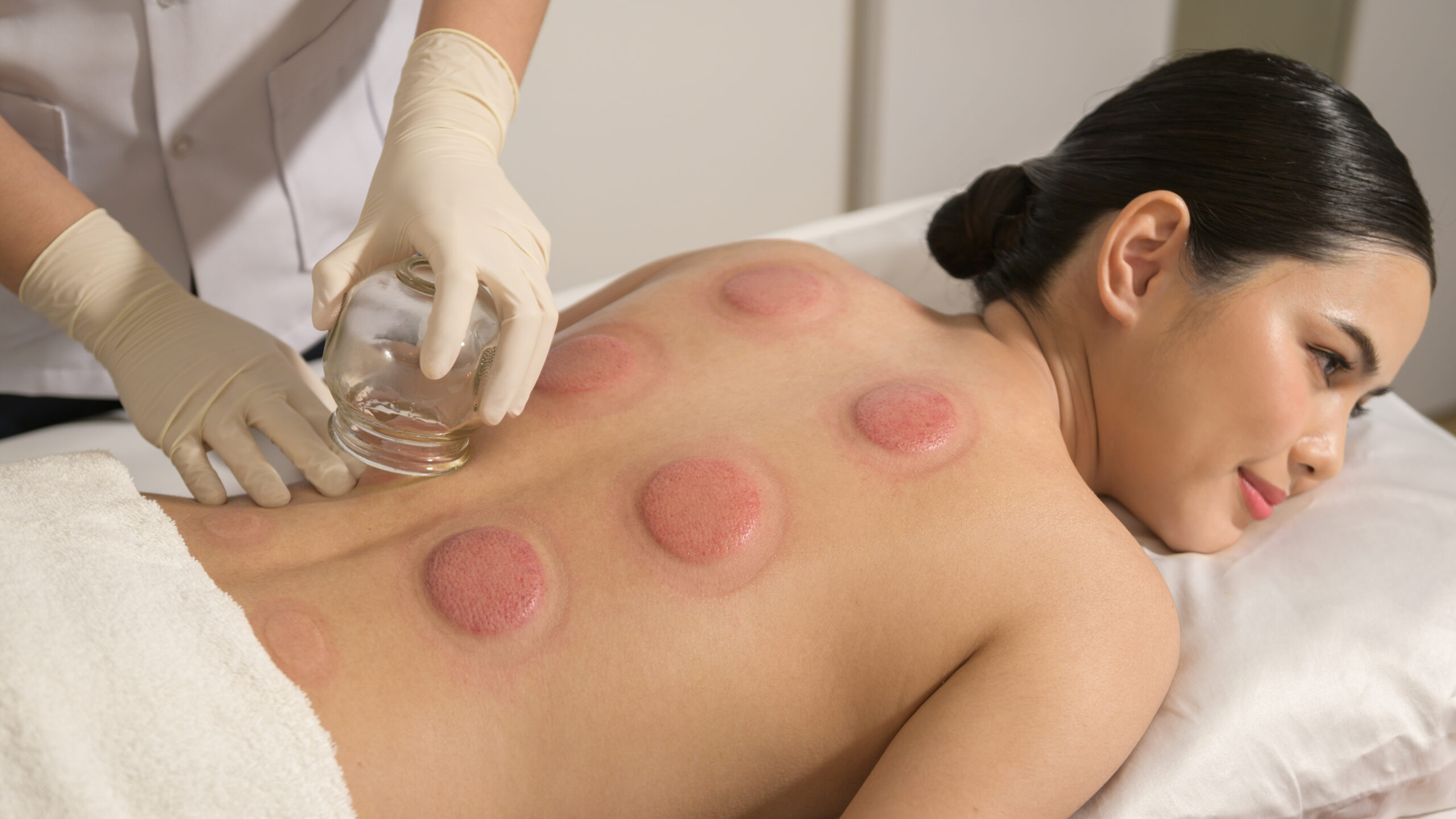 Woman Received cupping treatment on back by therapist