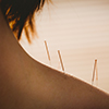 Young woman getting acupuncture treatment in therapy room