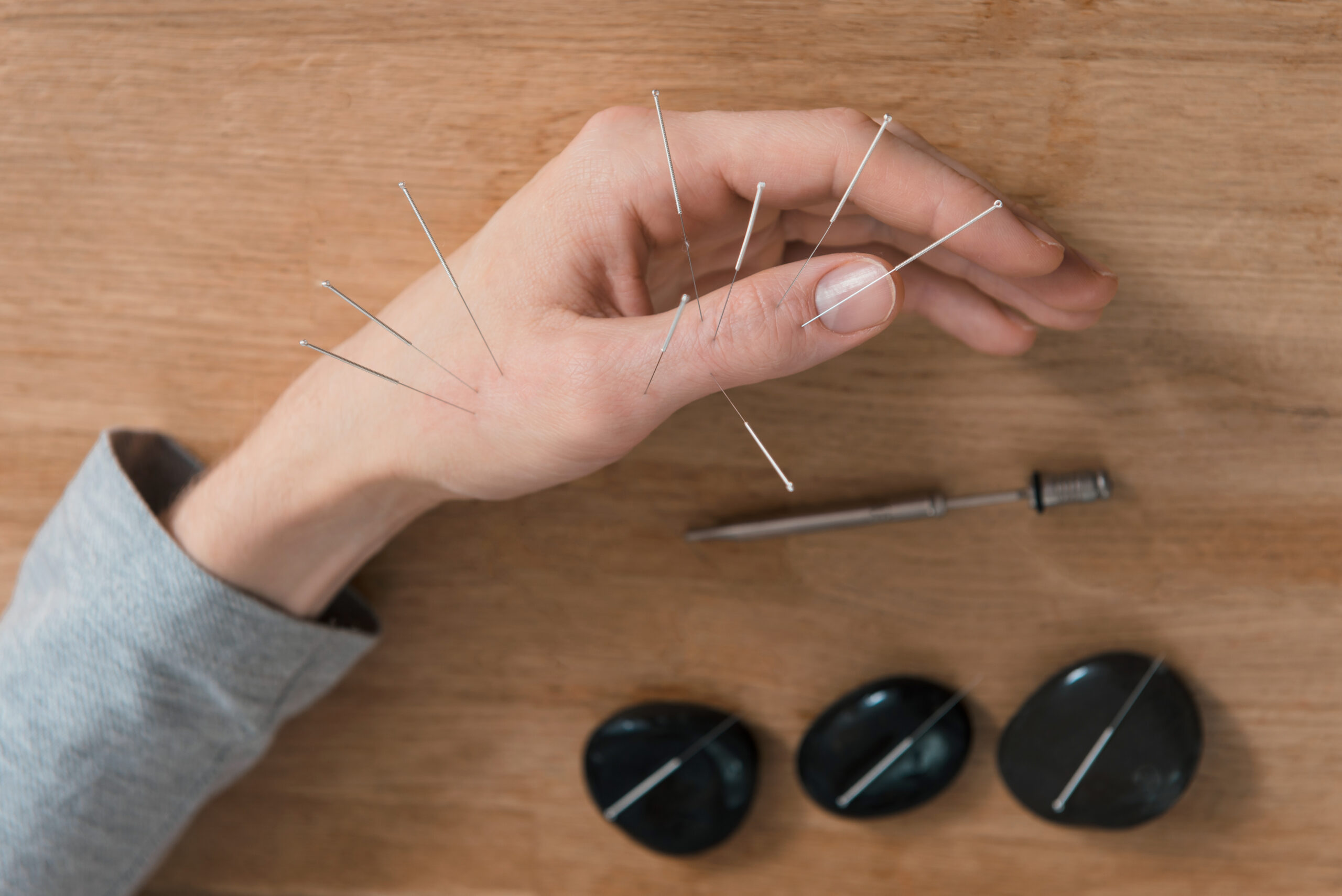 Man using acupuncture treatment for pain relief